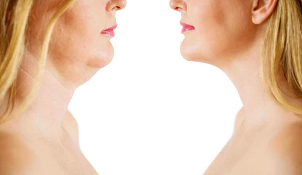 Double Chin treatment Epping Green before and after results