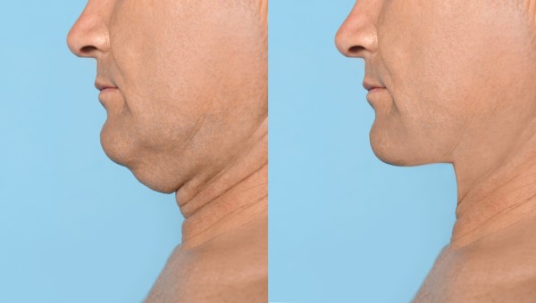 Which Non-Surgical Treatments Work Best for Jowls and Loose Skin Epping Green?