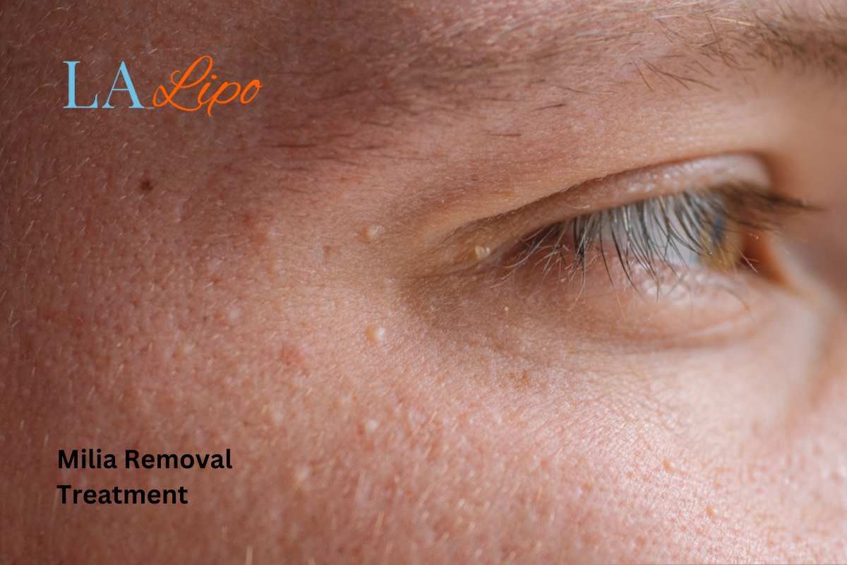 Cryopen Milia Removal: Is It the Easiest and Safest Option Epping Green?