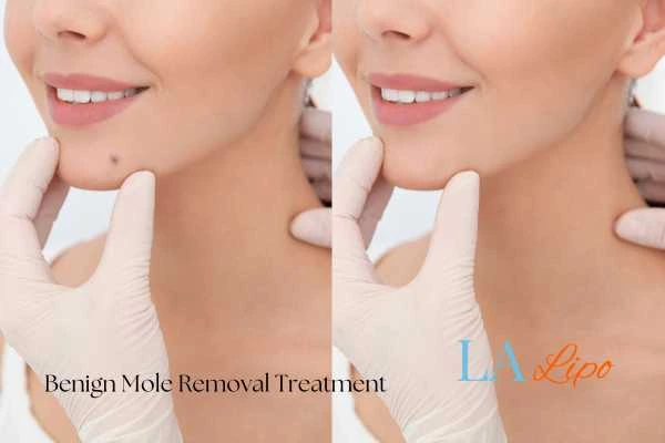 Before-and-after results following benign mole-removal treatment Epping Green