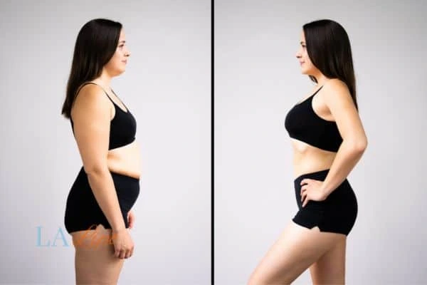 image of woman before and after results of LA-EMS Body Sculpting Epping Green to help treat Diastasis recti