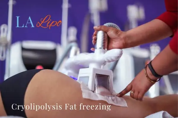 women getting fat freezing Epping Green