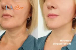 hi-fu for wrinkles Epping Green before and after results