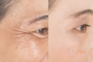 Before and after results of woman - HI-fu wrinkles reduction treatment Epping Green