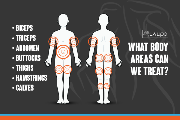 Graphic to show areas you can have LA-EMS Body Sculpting Epping Green treatment.