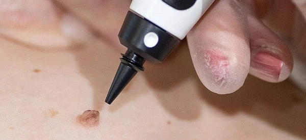 skin tag removal using cryopen Epping Green