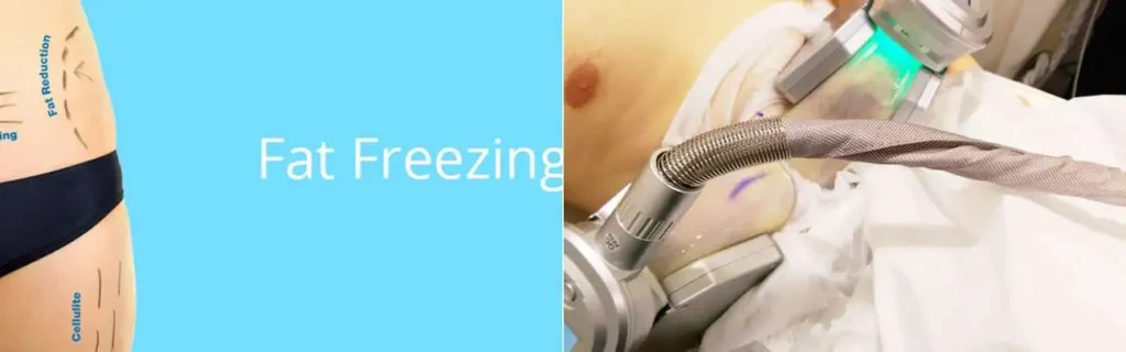 Fat freezing Epping Green on multiple areas of the body