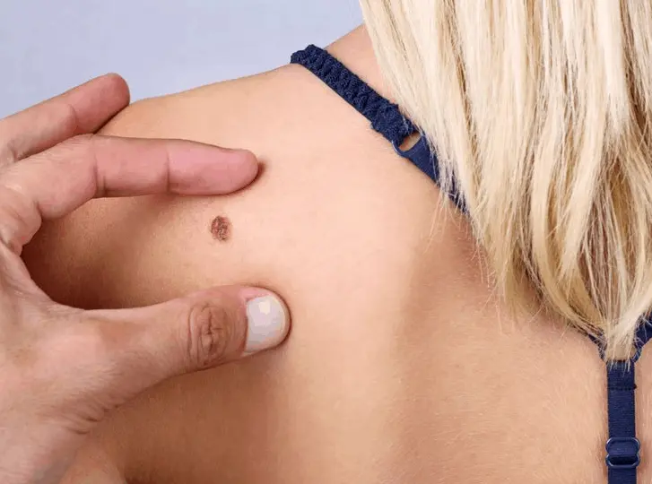 woman having mole removal Epping Green consultation before treatment.
