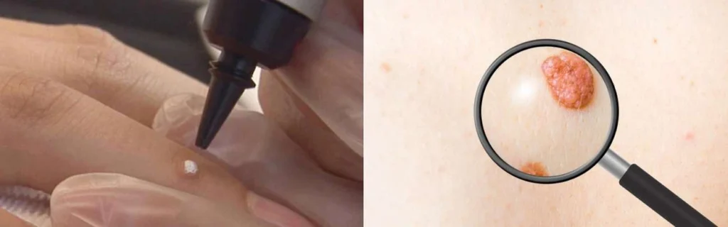 CryoPen practitioner Epping Green assessing a benign mole before treatment