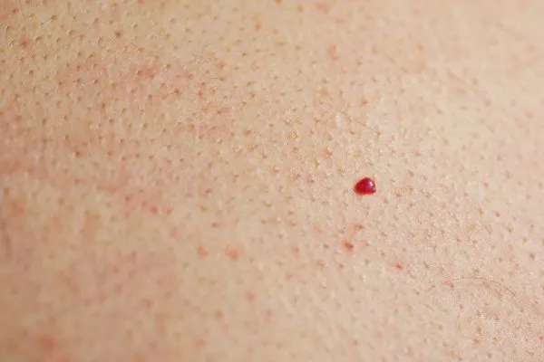 close up of a cherry angioma Epping Green