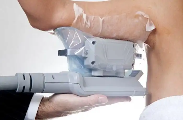 Picture of fat freezing Epping Green on the upper arms.