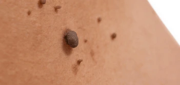image of a skin tag Epping Green