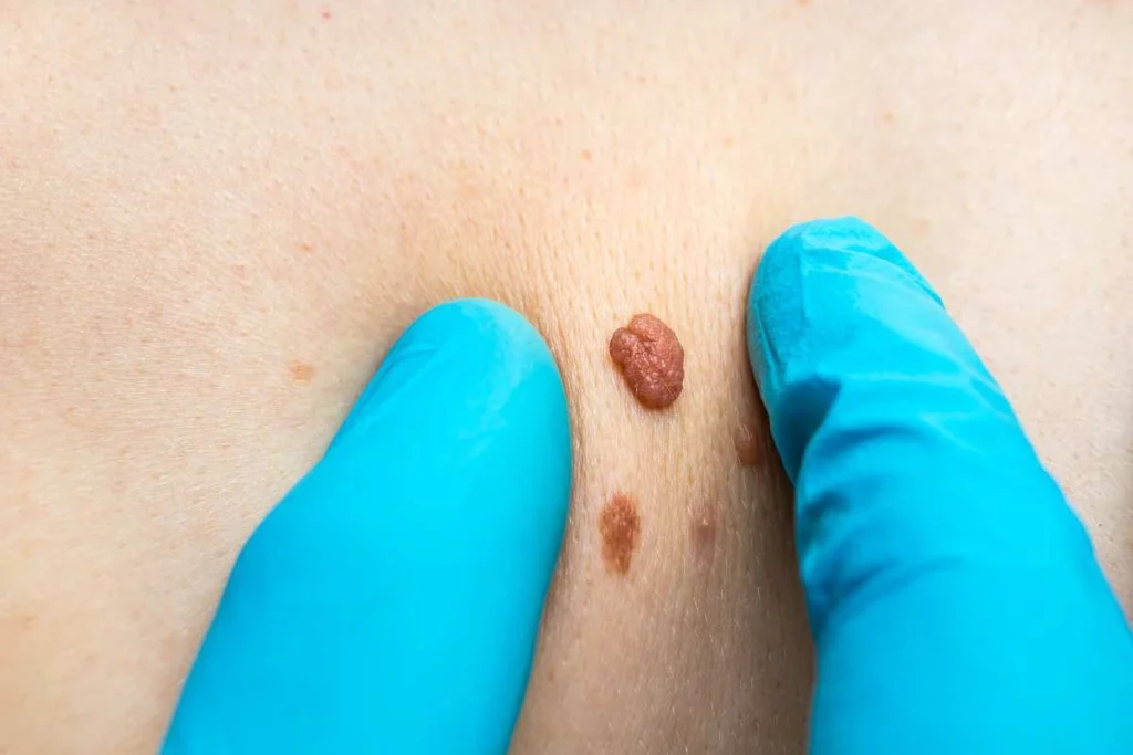 Consultant examining a skin tag Epping Green