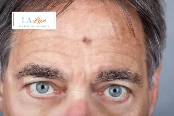 Solar Lentigo Removal Epping Green image of man with mark on his forehead