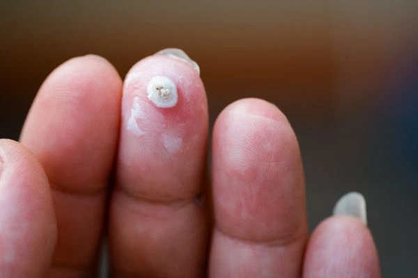 wart on person finger - cryotherapy to treat from LA LIPO Epping Green