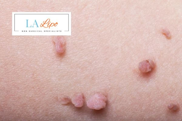 Does cryopen skin tag removal Epping Green hurt? Find out now call our team today!