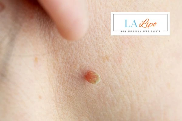Book skin tag removal Epping Green today speak to our team now!