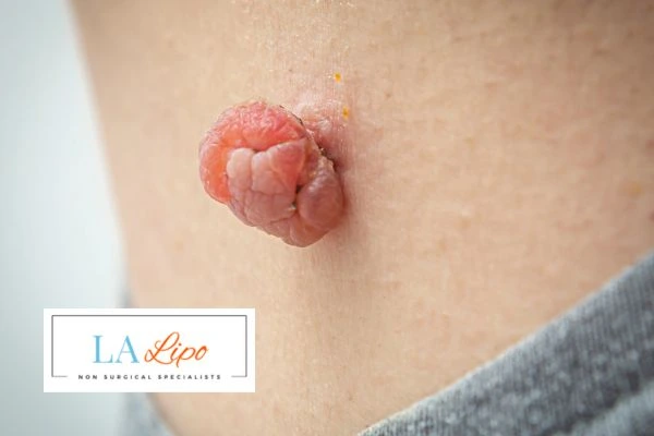 Interested in skin tag removal Epping Green? Concerned about the pain? Find out more today!