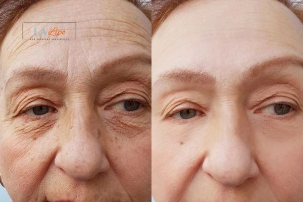 The powerful benefits of Morpheus8 Treatment Epping Green - Call Our team today!