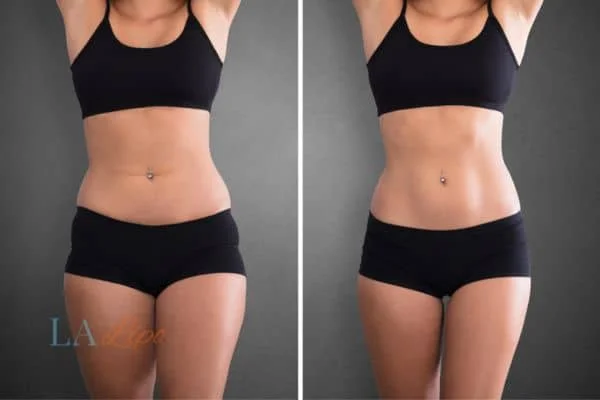 before and after results of non-surgical treatment to help a woman's body image and mental health Epping Green