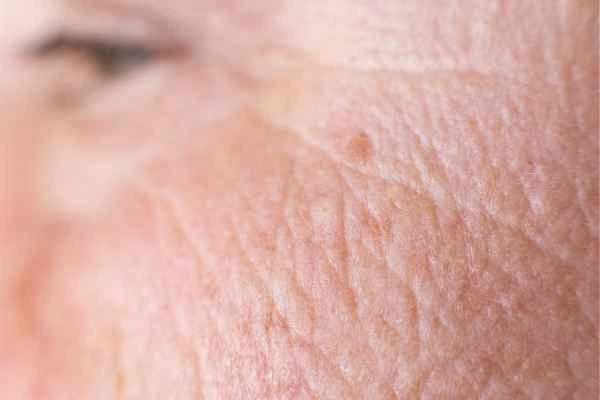 close up picture of a woman's face showing an age spot Epping Green