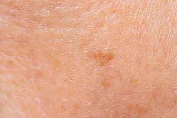 close up picture of age spots Epping Green