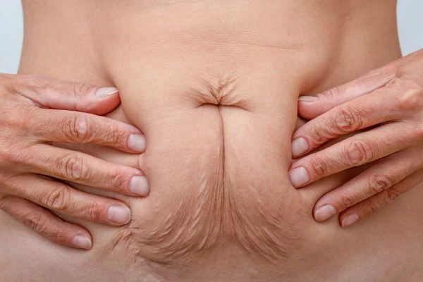 Should I Combine Diastasis Recti Treatment with Body Contouring for Better Results Epping Green?