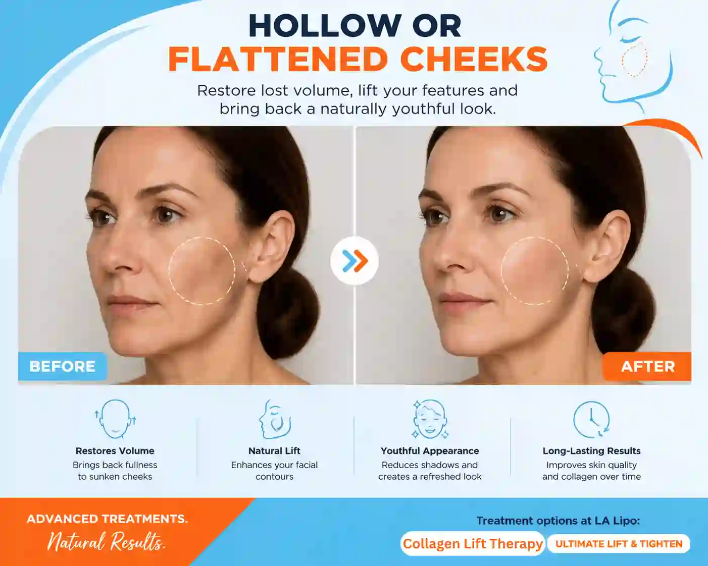 Sign #4: Hollow or Flattened Cheeks Epping Green