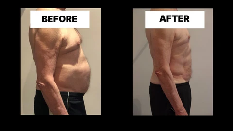 What Symptoms Can Diastasis Recti Cause in Men? Weak Core, Back Pain and Poor Posture Epping Green